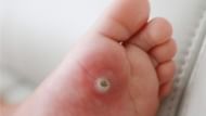 Warts are contagious. (Photo via Instagram/soletherapysydney)